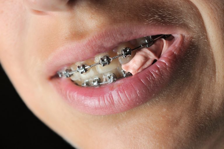 Can You Eat Gum with Braces? Expert Advice Revealed!
