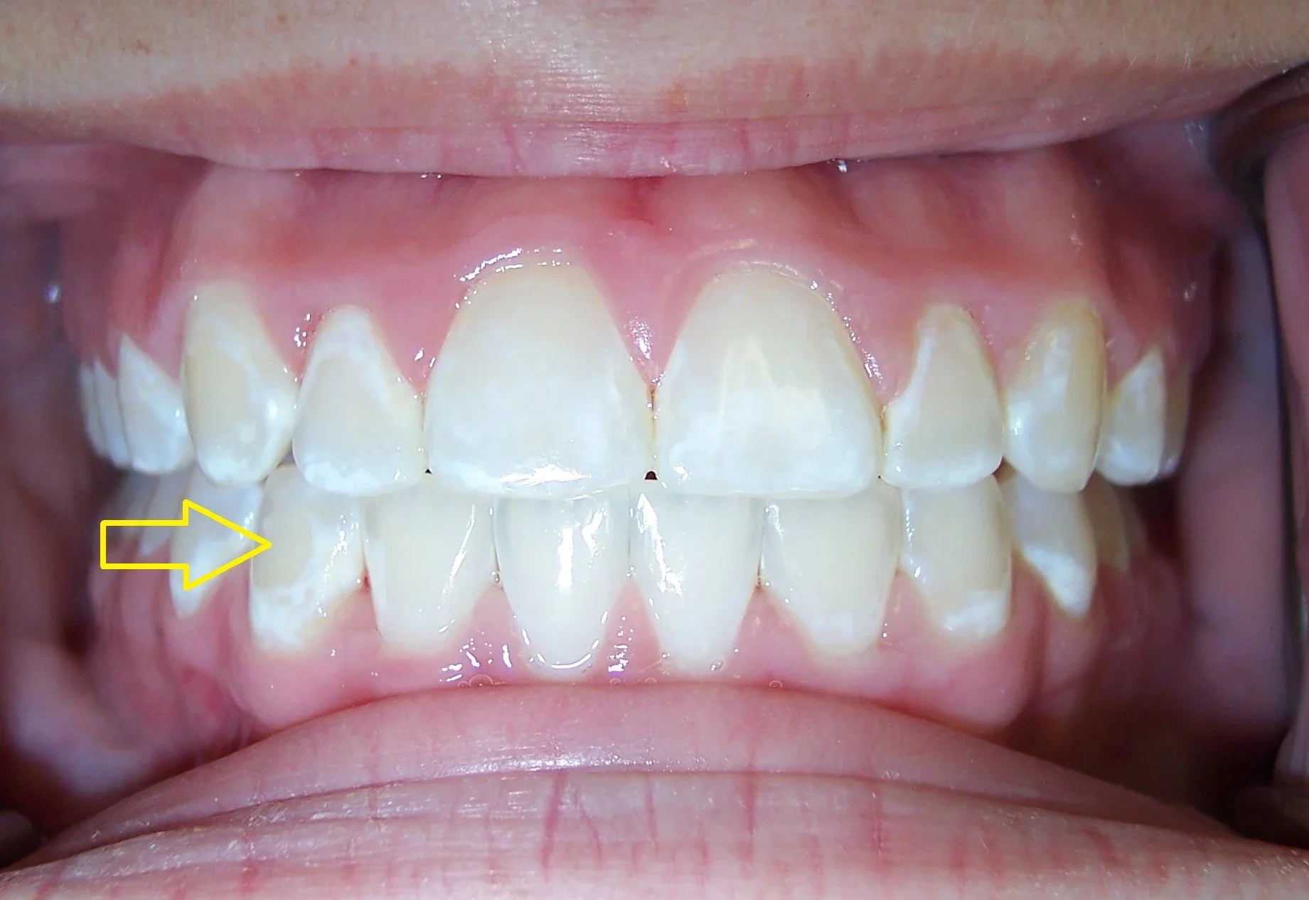 How to Get Rid of White Scars on Teeth