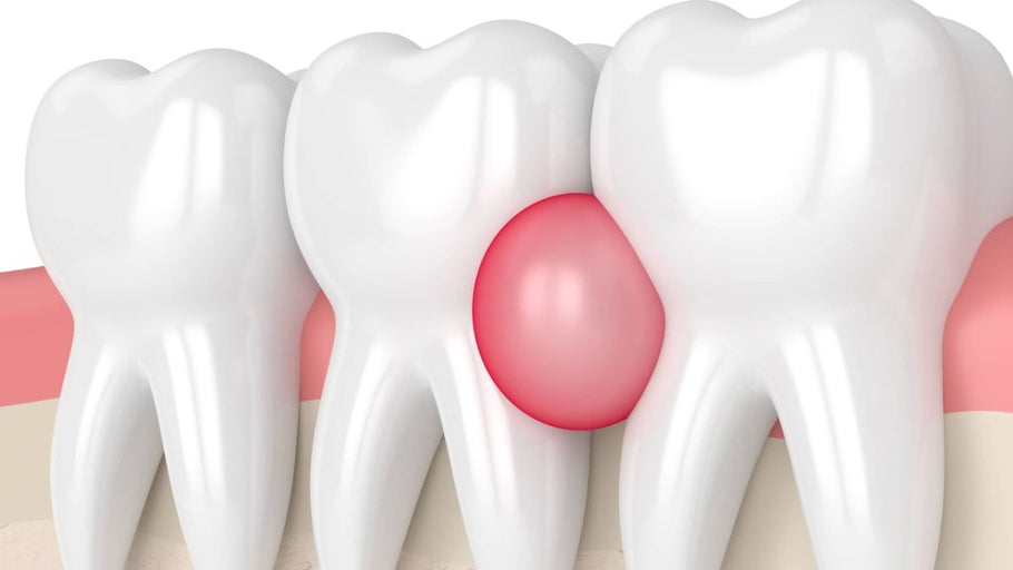 Can Popping a Gum Abscess Kill You?