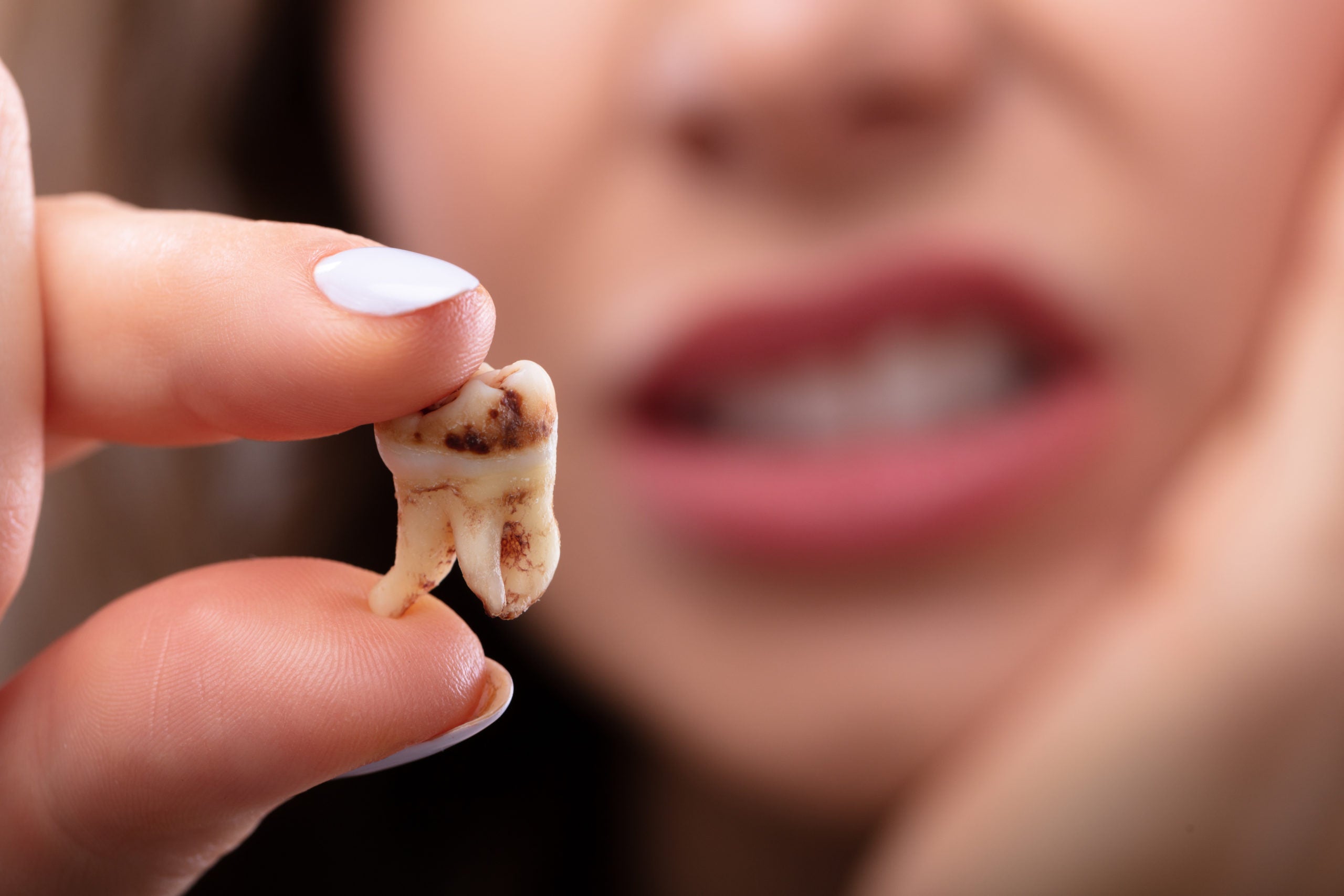 How to Remove Tooth Decay Yourself: Methods You Can Trust